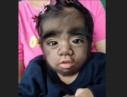 Bayi Filipina Derita Sindrom Manusia Serigala, Akibat Ibu Makan Kucing Liar Saat Hamil?