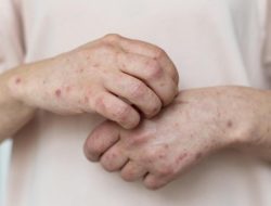 59 Jakarta Residents Infected With Monkey Pox, Homosexual Perpetrators Most Vulnerable To Attack