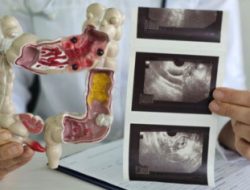 Ini Dia Penyebab Utama Risiko Kanker Usus Besar yang Lebih Tinggi pada Orang Dewasa Muda